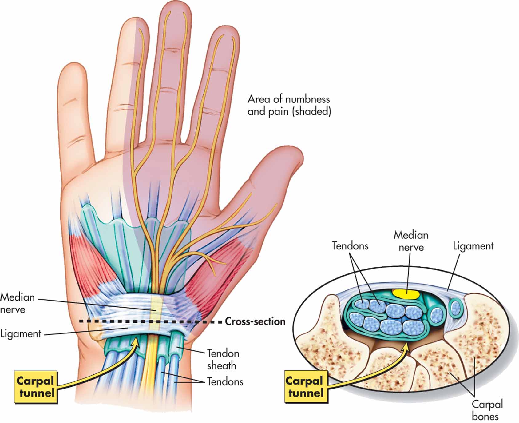 Carpal Tunnel Syndrome - My Family Physio
